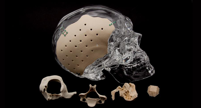 Нова технология заменя липсващи черепни кости 