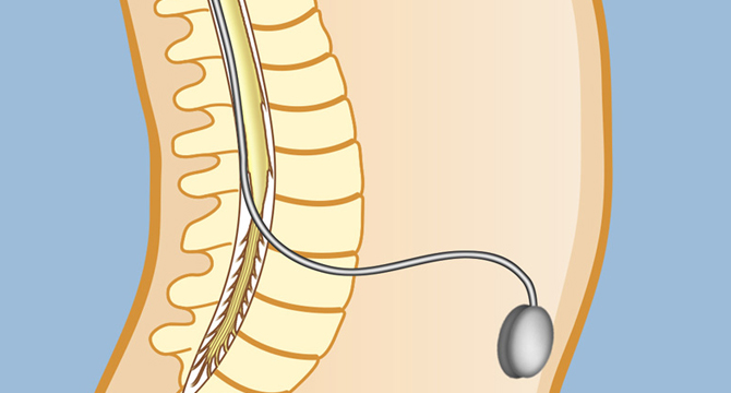 Два нови метода за невростимулация помагат на болни с парализа, мултиплена склероза и хронични болки в гърба 