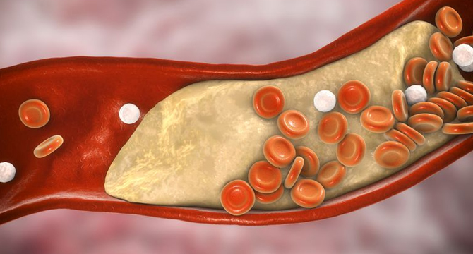 Какво да правим при висок холестерол? Стъпки към нормални нива на липидния профил