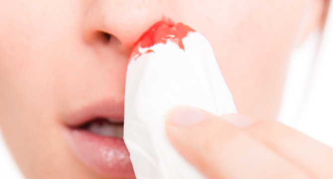 Защо ни тече кръв от носа и какво можем да направим?