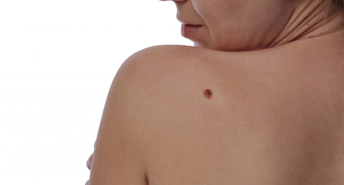 Колко опасен може да е ракът на кожата?