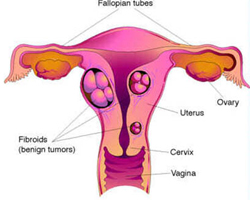 До колко е опасна миомата?