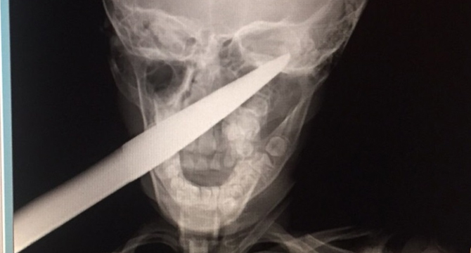 В УМБАЛ Бургас спасиха дете със забита в главата градинска ножица