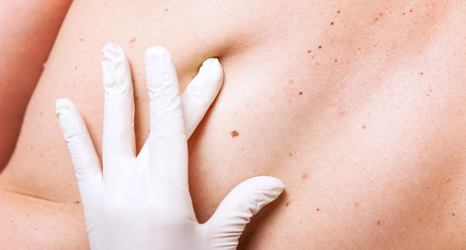 Рак на кожата - повече ли са случаите отпреди и защо?
