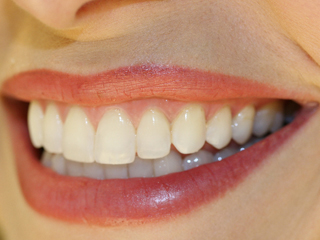 Защо венците кървят и как да се справим с проблема