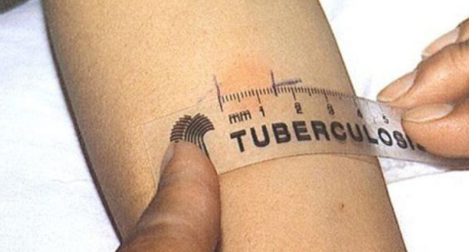 Безплатни прегледи за туберкулоза в цялата страна