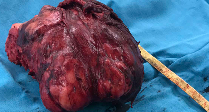 Лекари премахнаха тумор с размери на детска глава от коляно на пациент 